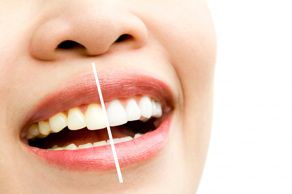 Reabilitação Oral: Como Transformar Sua Qualidade de Vida Através do Sorriso 1 Cafe mancha os dentes